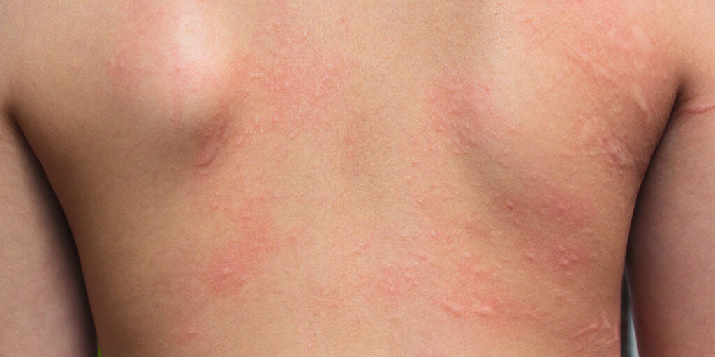 Contact Dermatitis